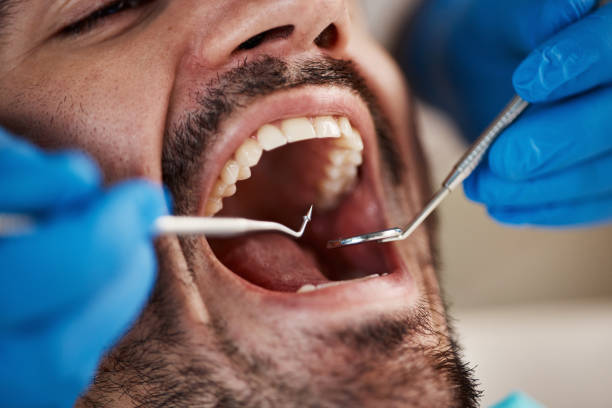 Best Emergency Dental Care for Broken or Chipped Teeth in Claremont, CA